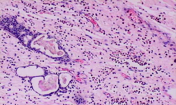 allergic nasal polyp