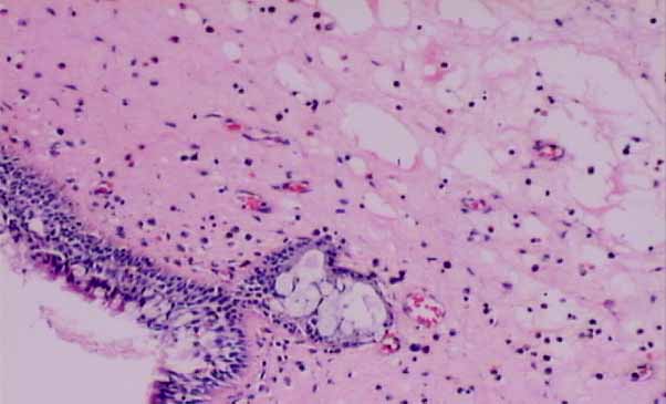 allergic nasal polyp