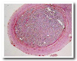 apcarcinoidmicro.JPG (20897 bytes)