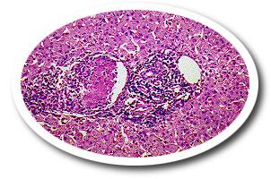 apportalpyemia.JPG (21196 bytes)