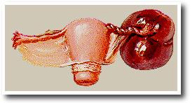 twistedovariancyst.JPG (9326 bytes)