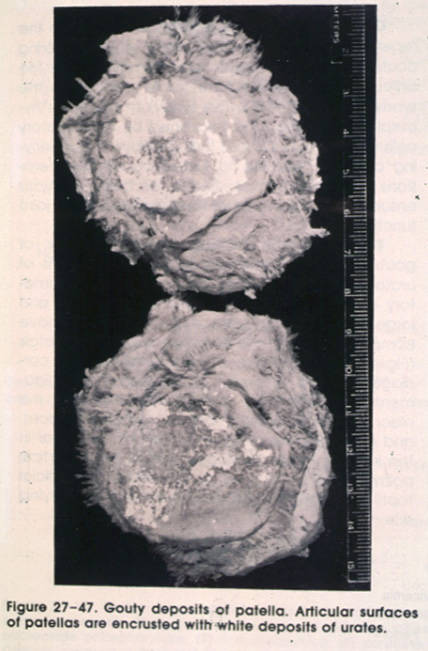 gout15chronic.jpg 102.9K