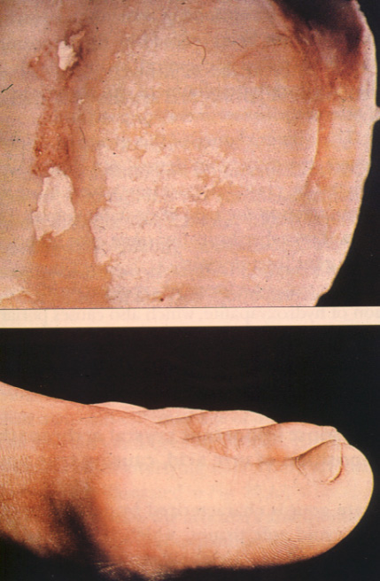 gout16chronic.jpg 107.1K