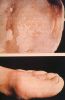 gout16chronic1.jpg 2.3K