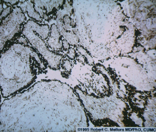 gout17lysosome.jpg 131.2K