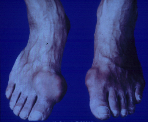 gout20tophiTOE.jpg 61.6K