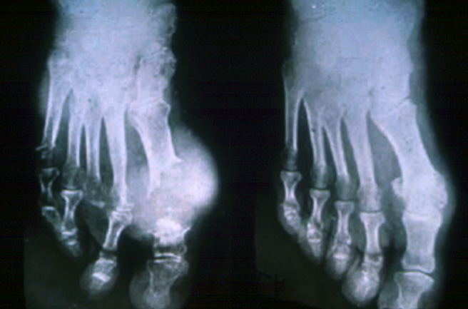 gout21tophiXRAY.jpg 73.5K