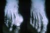 gout21tophiXRAY1.jpg 2.3K