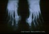 gout22tophiXRAY1.jpg 1.9K