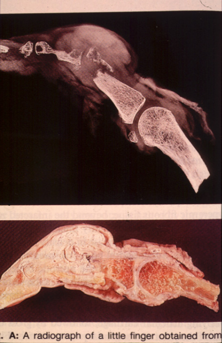 gout23tophi.jpg 109.3K