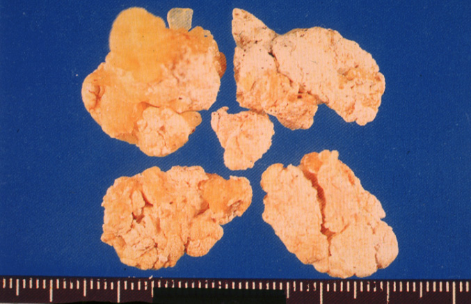 gout24tophiGROSS.jpg 129.0K