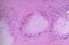 gout25tophiH&E1.jpg 2.2K
