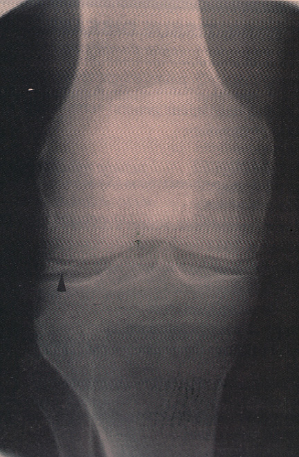 gout40pseudogout02.jpg 155.4K