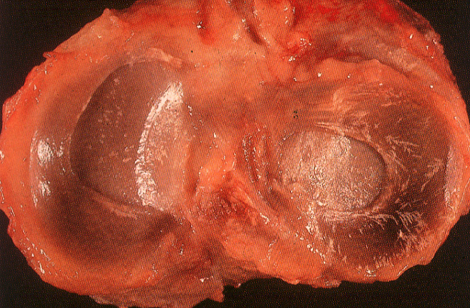 gout40pseudogout03.jpg 246.8K