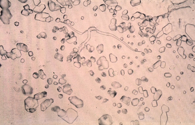 gout40pseudogout04.jpg 144.8K