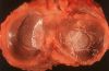 gout40pseudogout09.jpg 2.4K