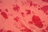 gout40pseudogout11.jpg 2.4K