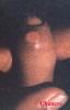 03chancre1.jpg 1.6K