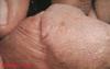 06psoriasis1.jpg 1.7K