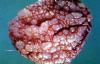 08condyloma1.jpg 2.6K