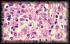 05malacoplakia2.jpg 2.9K