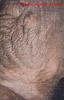 01chroniceczema1.jpg 2.0K
