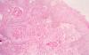 06sqcarcinomascrotum3.jpg 1.7K