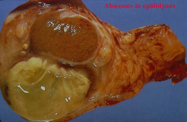 08abscessinepididymis.jpg 36.8K