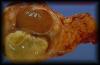 08abscessinepididymis1.jpg 1.9K