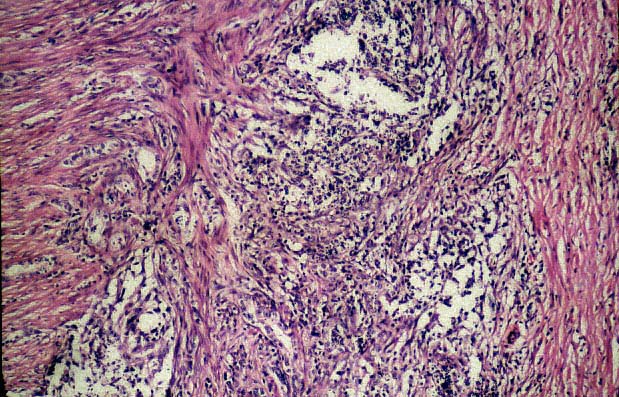 09spermaticgranuloma1.jpg 114.1K