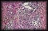 09spermaticgranuloma2.jpg 2.9K