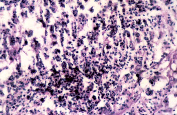 10spermaticgranuloma2.jpg 76.1K