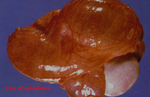 11cystofepididymis.jpg 32.4K