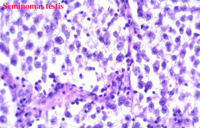 20seminoma1.jpg 59.4K