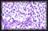 20seminoma2.jpg 3.1K