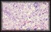 21spermatocyticseminoma3.jpg 2.6K