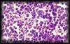 22spermatocyticseminoma2.jpg 3.5K