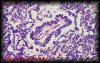 25yolksactumor2.jpg 3.4K