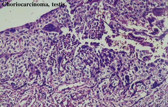 34choriocarcinoma.jpg 85.9K