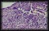 34choriocarcinoma1.jpg 3.1K