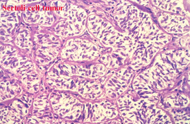 35sertolicelltumor1.jpg 80.9K