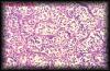 35sertolicelltumor2.jpg 3.2K