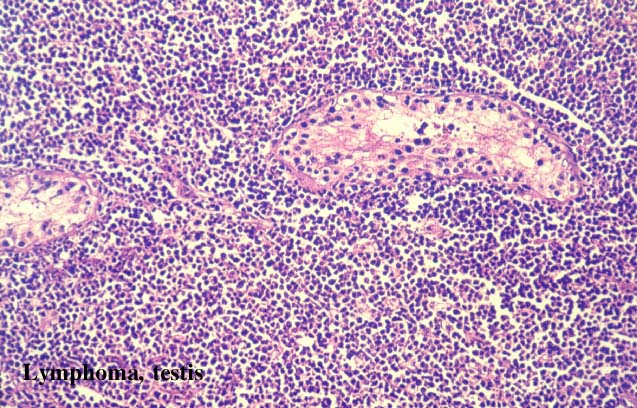 37lymphomatestis1.jpg 114.7K
