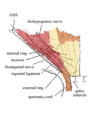 herniaincision.JPG (44139 bytes)