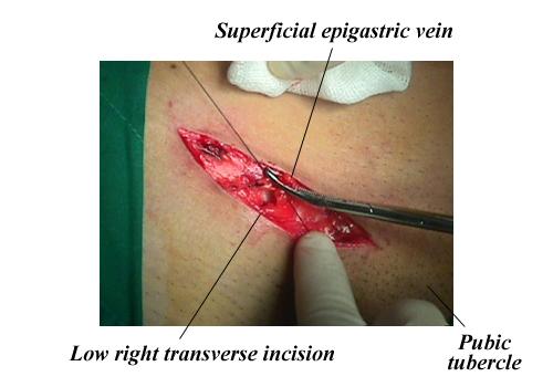 herniar01.jpg (96407 bytes)