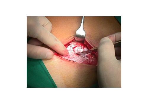 herniar06.jpg (81187 bytes)