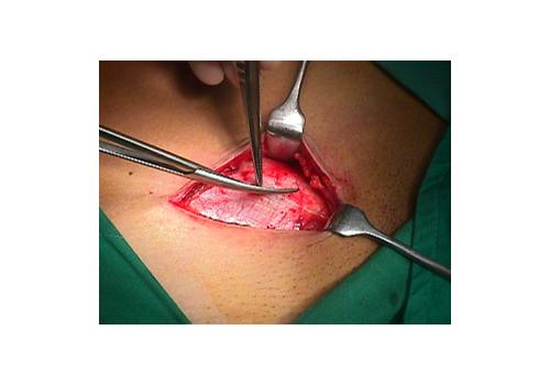 herniar07.jpg (88227 bytes)