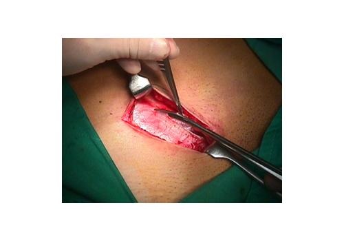 herniar08.jpg (84454 bytes)
