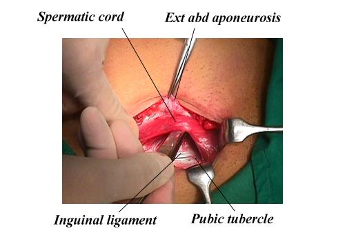 herniar10.jpg (100983 bytes)