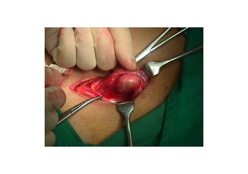 herniar11.jpg (83543 bytes)
